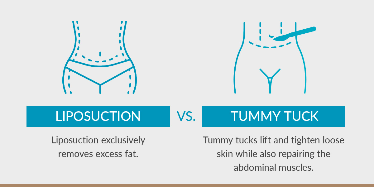Liposuction vs. Tummy Tuck: Procedure Comparison 
