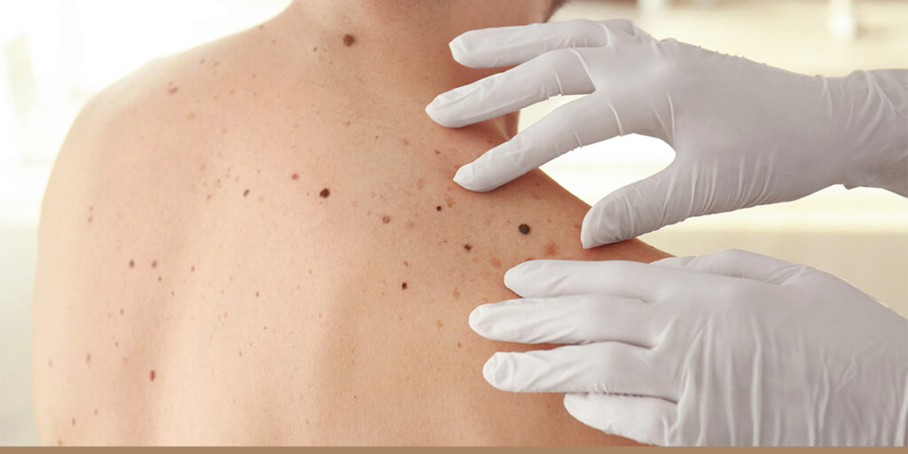 Everything You Need to Know About Mole Removal