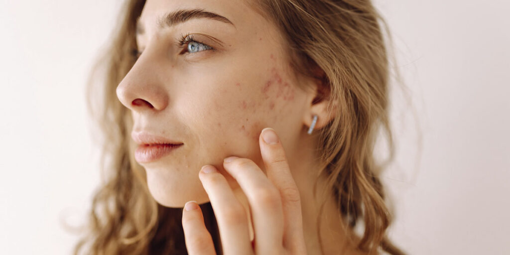 how to Treat Rosacea