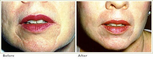Laser Skin Resurfacing for Acne Scars