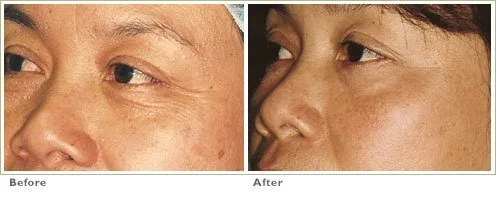 Laser Skin Resurfacing