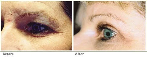 Laser Skin Resurfacing