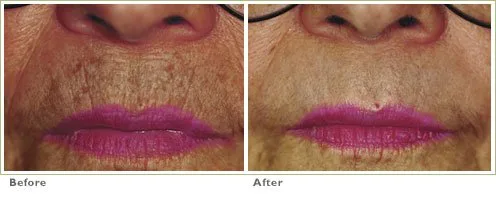 Laser Skin Resurfacing