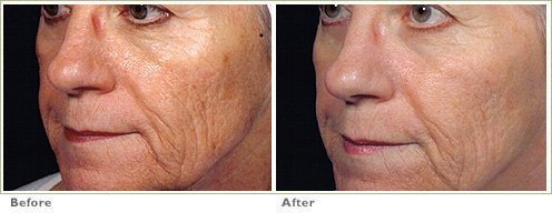 wrinkles aging7