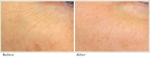 Fraxel™ Laser Treatment