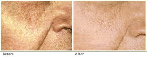 face peels for wrinkles AND BROWN SPOTS