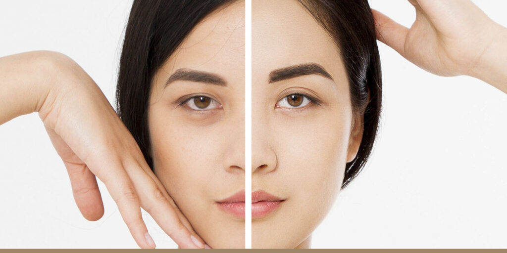 Microdermabrasion vs. Chemical Peels: Which Is Right For You?