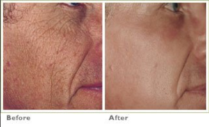 laser wrinkle treatment