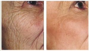 laser wrinkle treatment