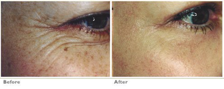 laser wrinkle treatment