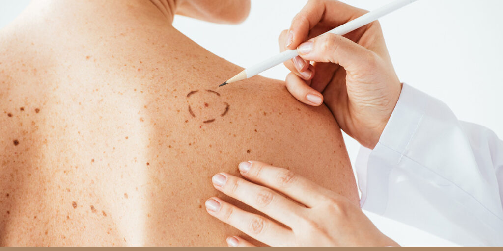 01 Skin Cancer Treatments Explained